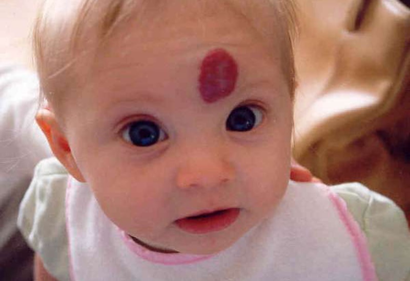 Bướu máu thường xuất hiện trong những năm đầu đời của trẻ