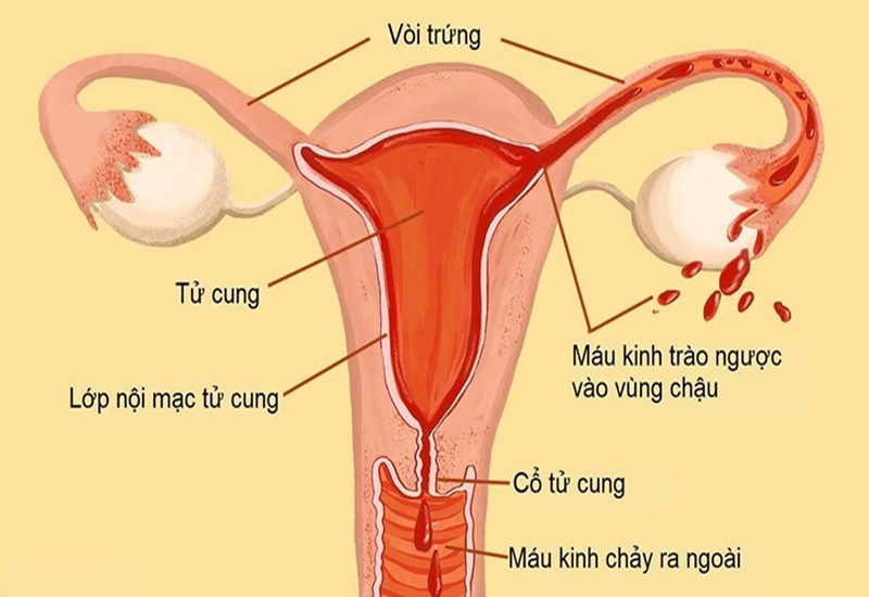 Rất nhiều nguyên nhân dẫn đến viêm nội mạc tử cung