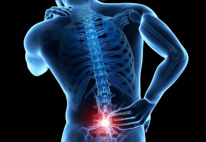 Hội chứng rễ thần kinh có thể khiến bệnh nhân bị đau nhức vùng cột sống thắt lưng