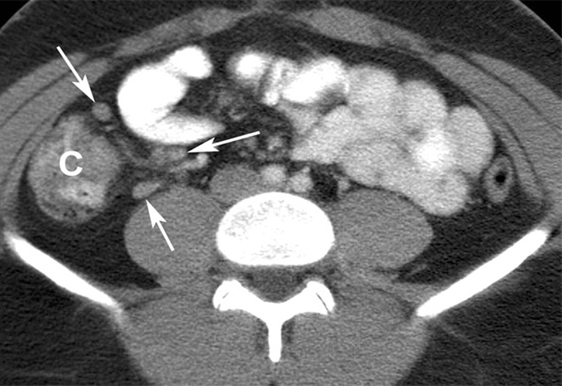 Kết quả chụp CT cho thấy hình ảnh viêm hạch mạc treo