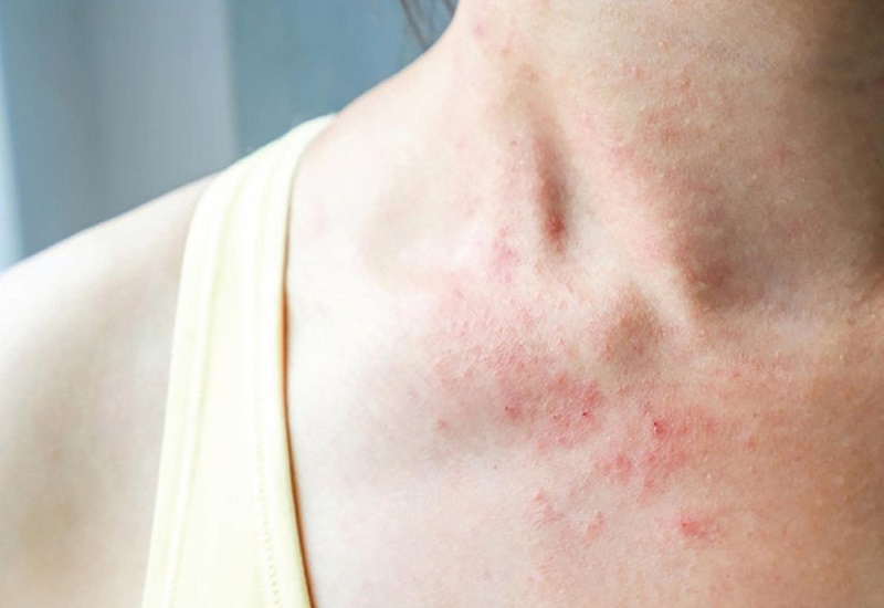 Mẩn đỏ da cũng là một biểu hiện bệnh phổ biến