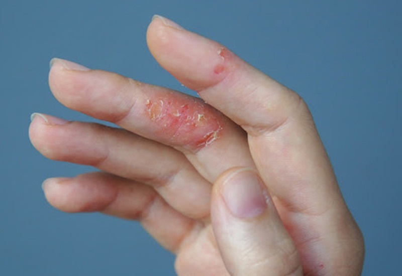 Viêm da cơ địa có thể gặp ở nhiều vùng da trên cơ thể