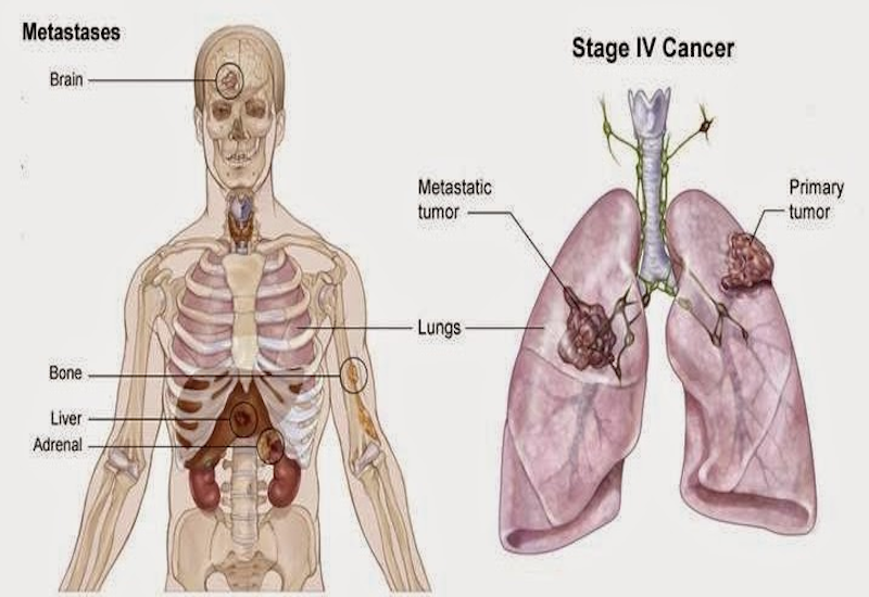 Di căn được xem là giai đoạn cuối của các loại ung thư, trong đó có ung thư phổi