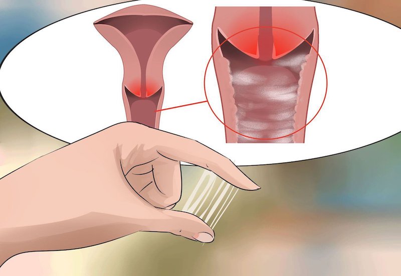 Khí hư và chảy máu âm đạo bất thường là những triệu chứng cảnh báo chứng loạn sản cổ tử cung