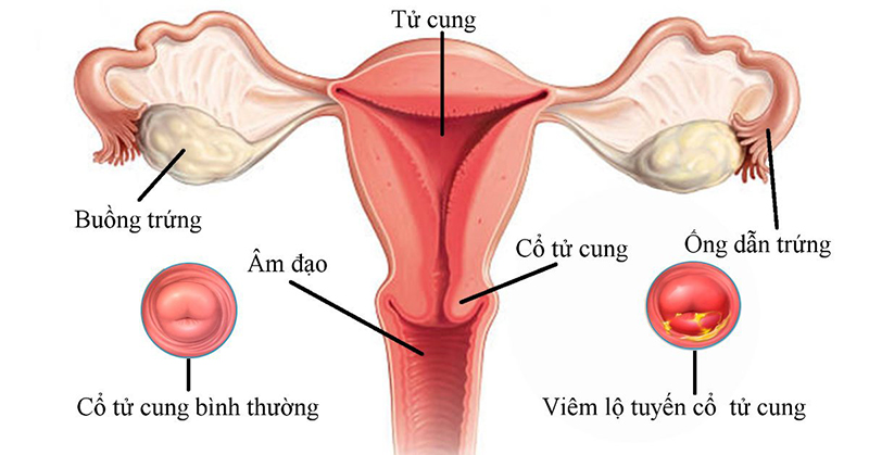   Viêm lộ tuyến cổ tử cung là bệnh lý khiến nhiều chị em lo lắng 