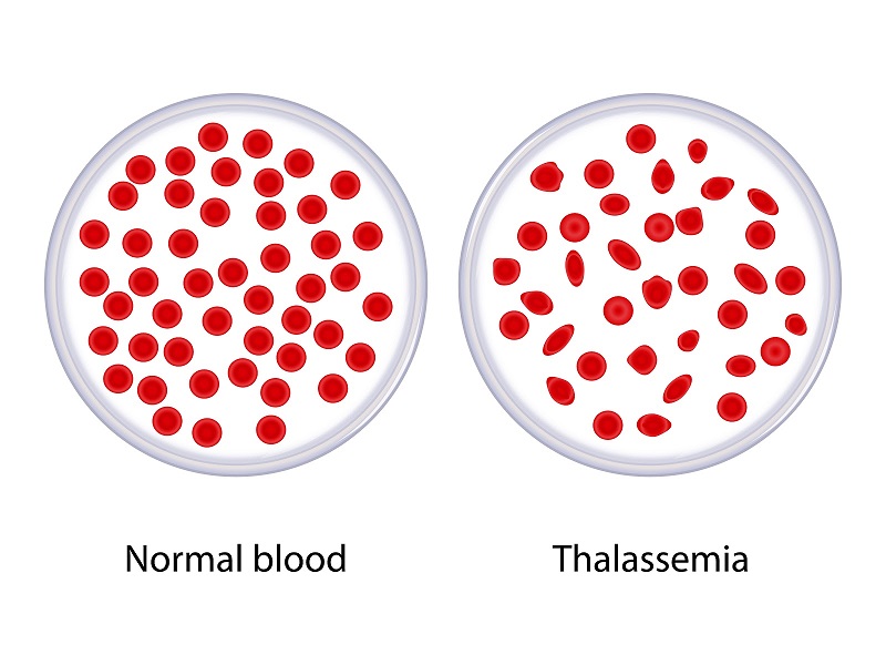 Bệnh nhân mắc tan máu bẩm sinh sẽ có nhiều hình dạng khác thường của hồng cầu trong máu