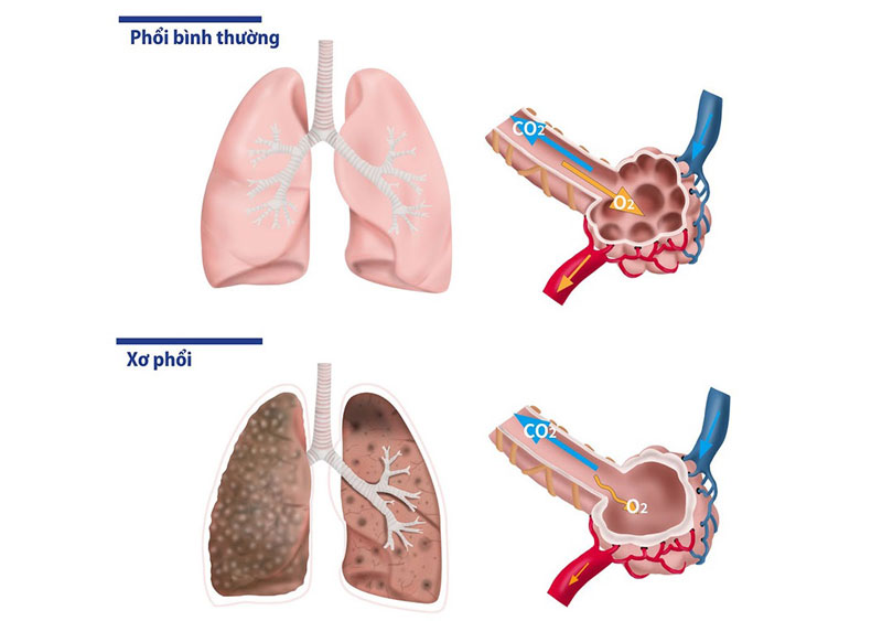 Xơ hóa phổi sẽ hình thành các vết sẹo ở mô phổi