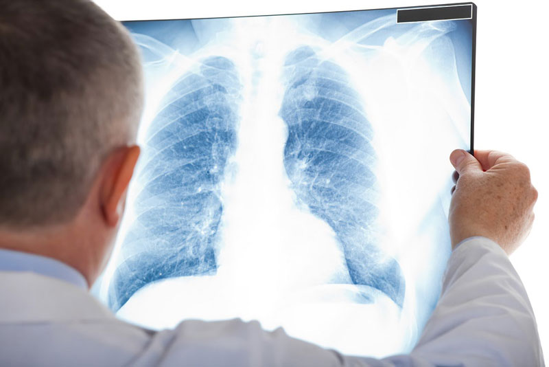 Xơ phổi sau lao là nguyên do chủ yếu dẫn đến bệnh