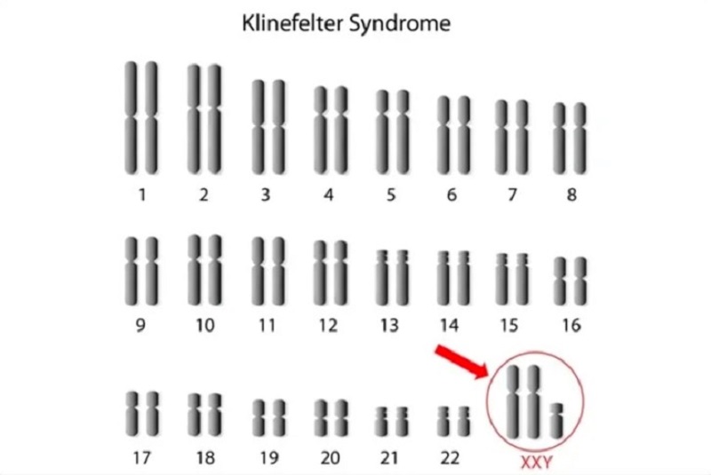 Hội chứng Klinefelter xảy ra ở bé trai ngay từ chào đời đã mang trong mình thêm một nhiễm sắc thể X 