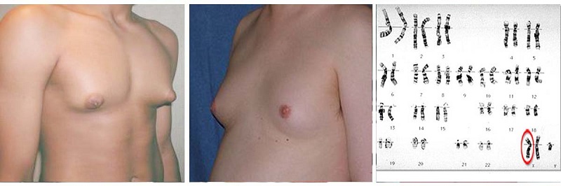 Nam giới mắc Klinefelter thường phát triển ngực to hơn so với bình thường