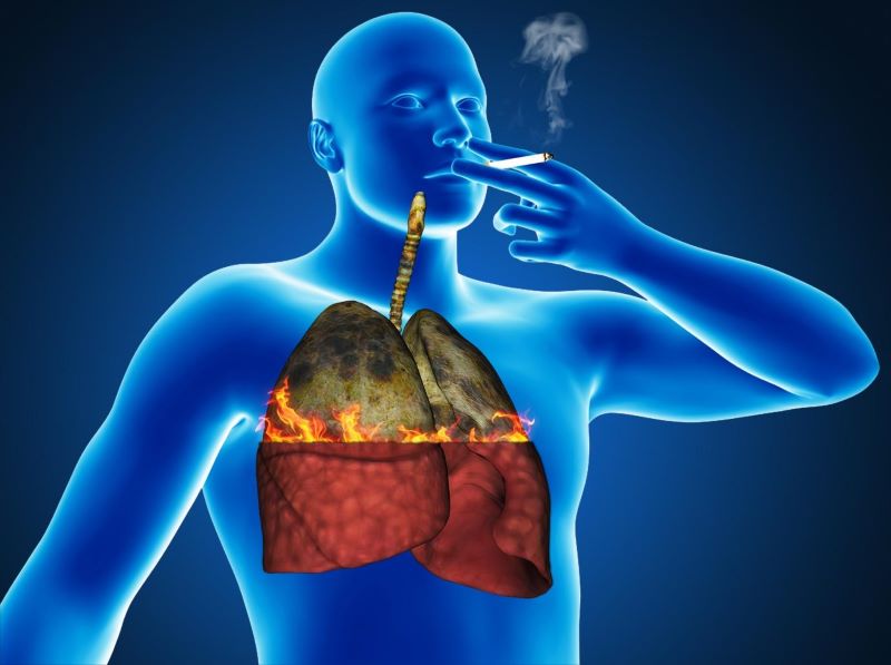 Hút thuốc là nguyên nhân hàng đầu gây bệnh ung thư phổi 