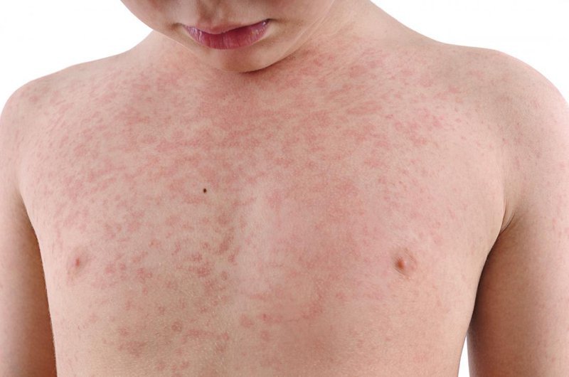 Tổn thương dạng ban đỏ do virus Rubella gây ra trên da