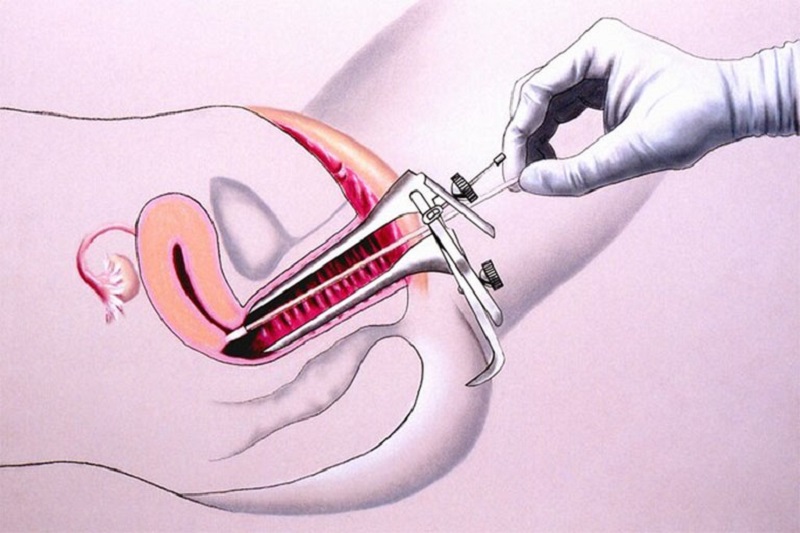 Thủ thuật sinh thiết cổ tử cung được thực hiện để làm gì?