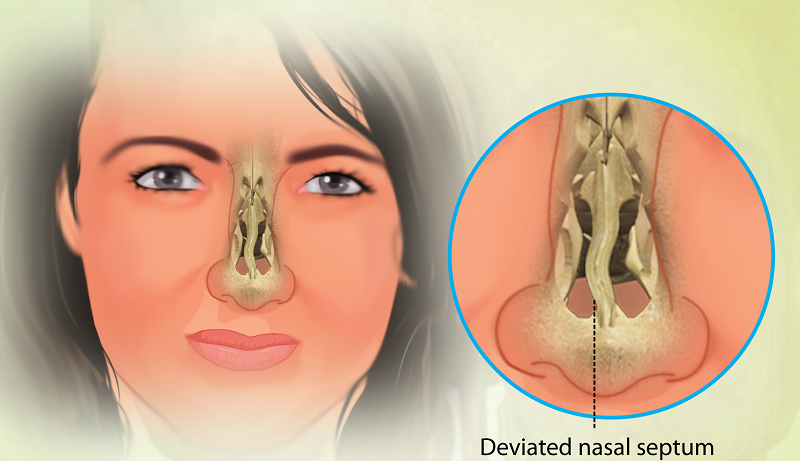 Mô phỏng tình trạng lệch vách ngăn mũi