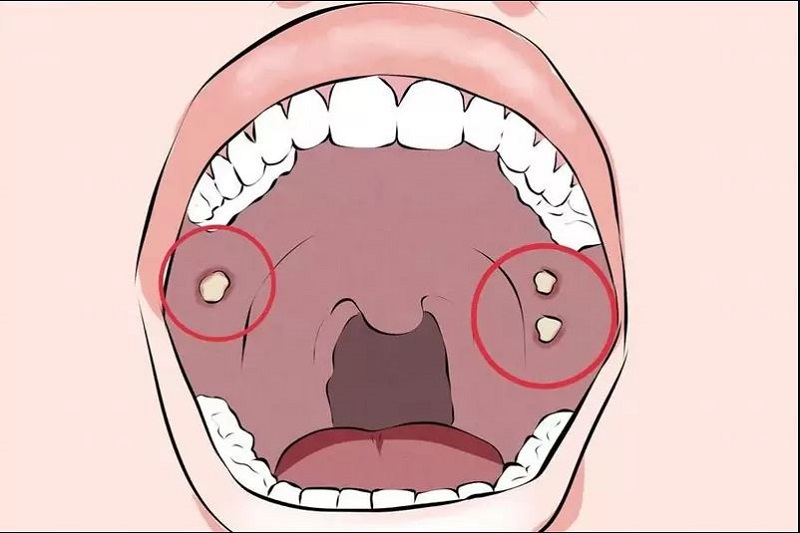Thức ăn dư thừa lắng đọng khiến vi khuẩn hoạt động trong cổ họng sinh ra sỏi amidan 