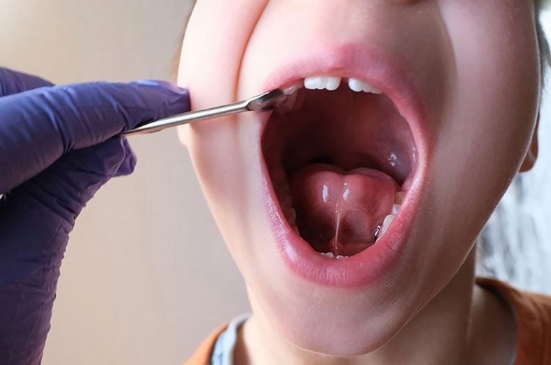 Cắt thắng lưỡi ở trẻ là phương pháp điều trị thường được chỉ định