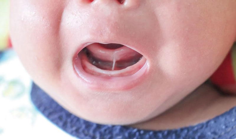 Có khoảng 5% trẻ mới sinh gặp dị tật dính thắng lưỡi