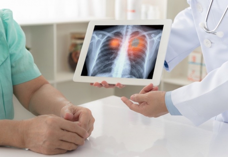 U phổi được chia thành 2 loại là u phổi lành tính và u phổi ác tính