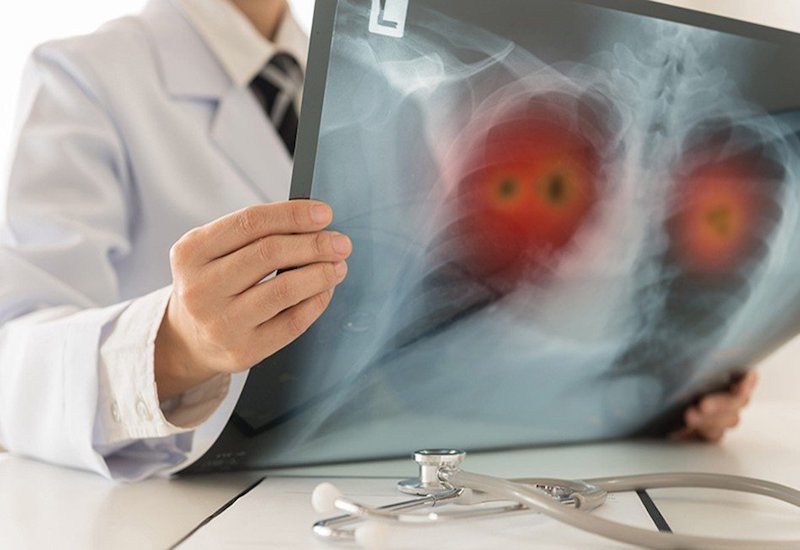 Bệnh u phổi có chữa được không còn tùy thuộc vào nhiều yếu tố khác nhau
