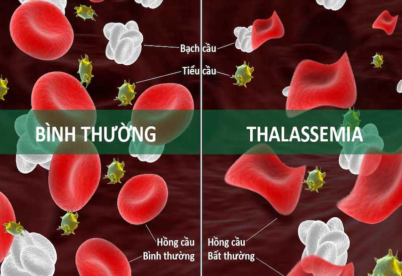 Mô phỏng bệnh Thalassemia tác động tới các tế bào hồng cầu