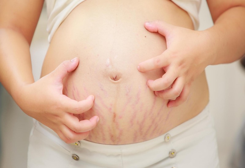 Tùy từng cơ địa, những vết rạn da sẽ bắt đầu xuất hiện trên cơ thể mẹ ở giai đoạn 3 tháng cuối thai kỳ