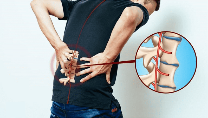Đau lưng kéo dài tối thiểu 3 tháng là triệu chứng đặc trưng ở người bị viêm cột sống dính khớp