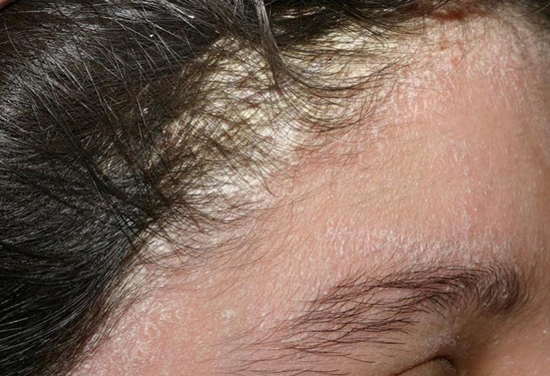 Nấm da đầu ảnh hưởng đến thẩm mỹ, khiến người bệnh cảm thấy tự ti