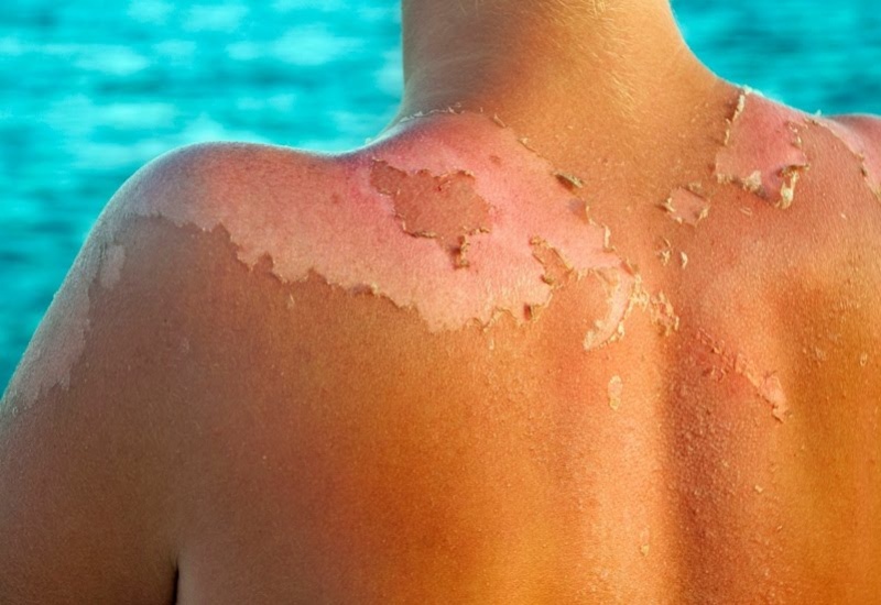 Tình trạng làn da bị cháy nắng xảy ra khi phải tiếp xúc trong thời gian dài với tia UV từ ánh nắng mặt trời