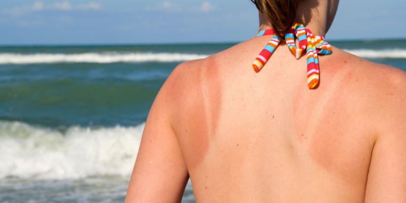 Tình trạng da bị cháy nắng phải mất ít nhất vài giờ để giảm bớt hoặc thậm chí kéo dài vài tuần