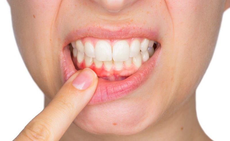 Chảy máu chân răng có thể khiến nhiều người nhầm tưởng bị chảy máu cổ họng