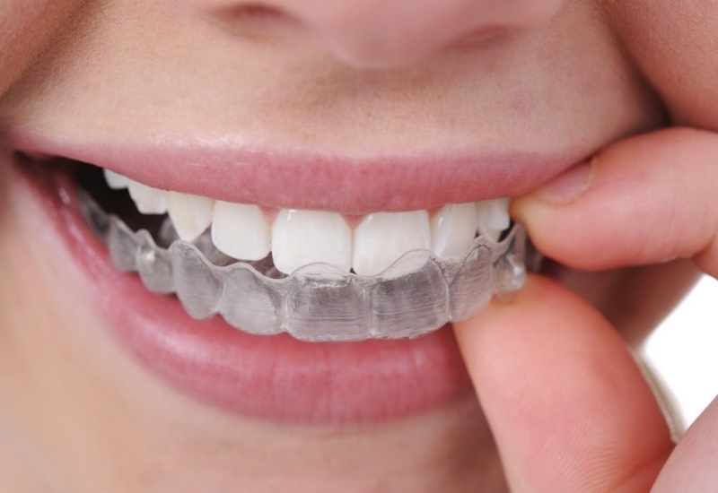 Có thể sử dụng máng tẩy trắng răng tại nhà theo sự hướng dẫn của bác sĩ