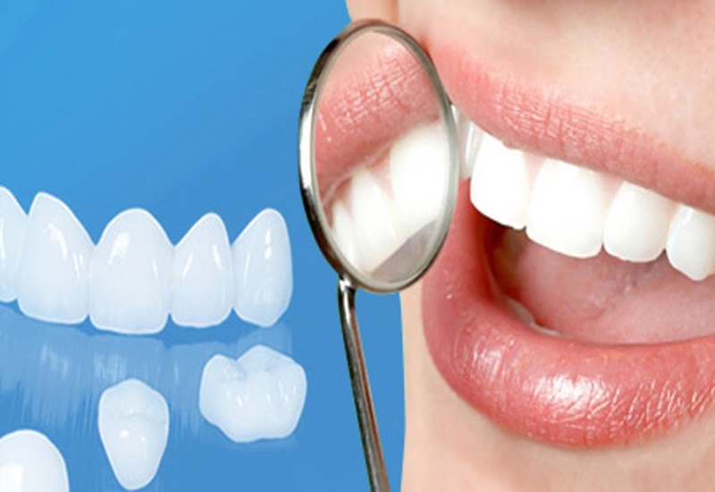 Bọc răng sứ là phương pháp cải thiện bệnh hiệu quả