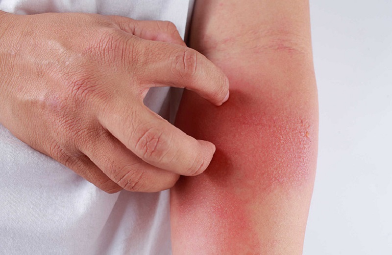 Viêm da tiếp xúc là bệnh dễ mắc nhưng lại khó điều trị sứt điểm 