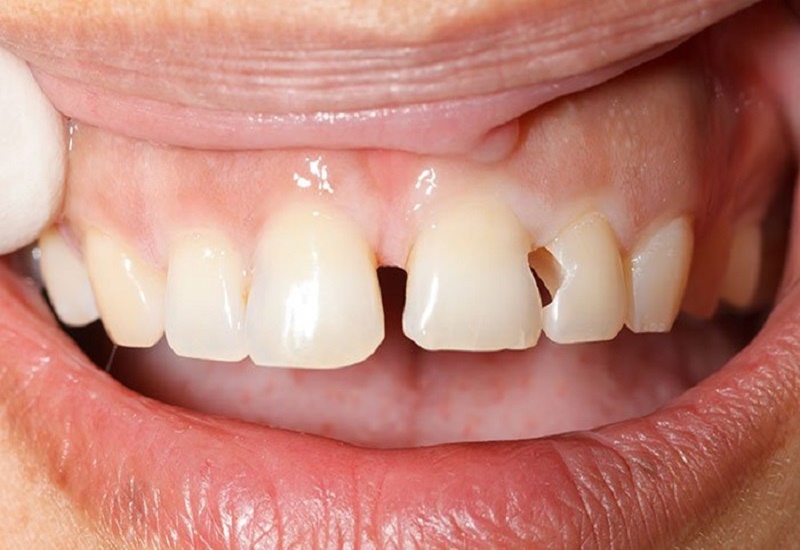 Mẻ răng khiến người bệnh mất tự tin