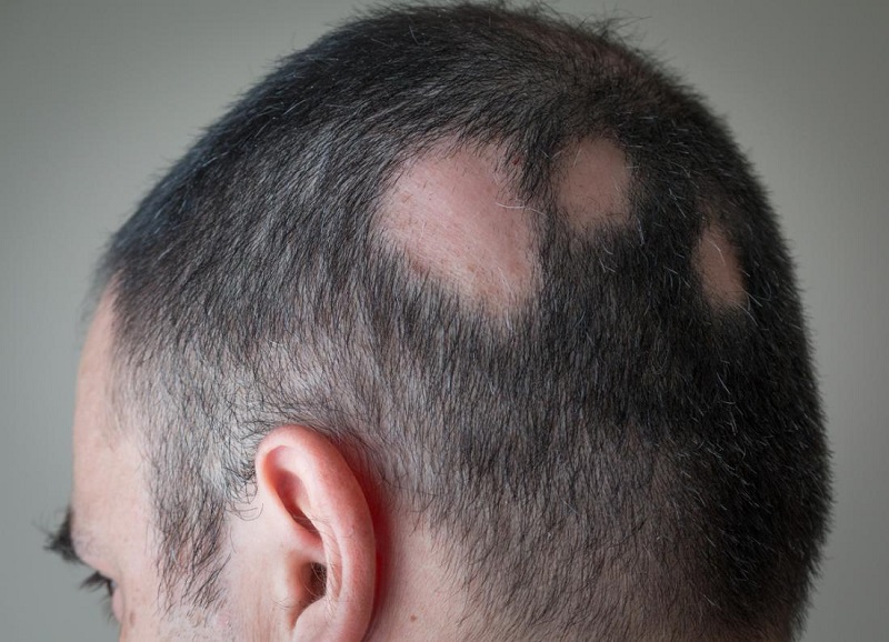 Bệnh rụng tóc mảng là nỗi ám ảnh của cả nam và nữ