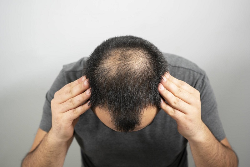 Rụng tóc mảng là căn bệnh khó điều trị
