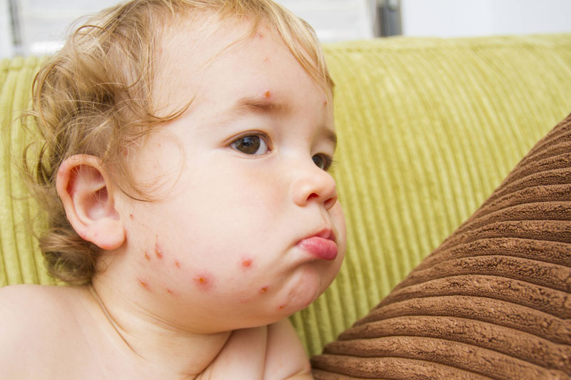 Trẻ mắc thủy đậu thường kèm theo các triệu chứng khác gây khó chịu cho bé