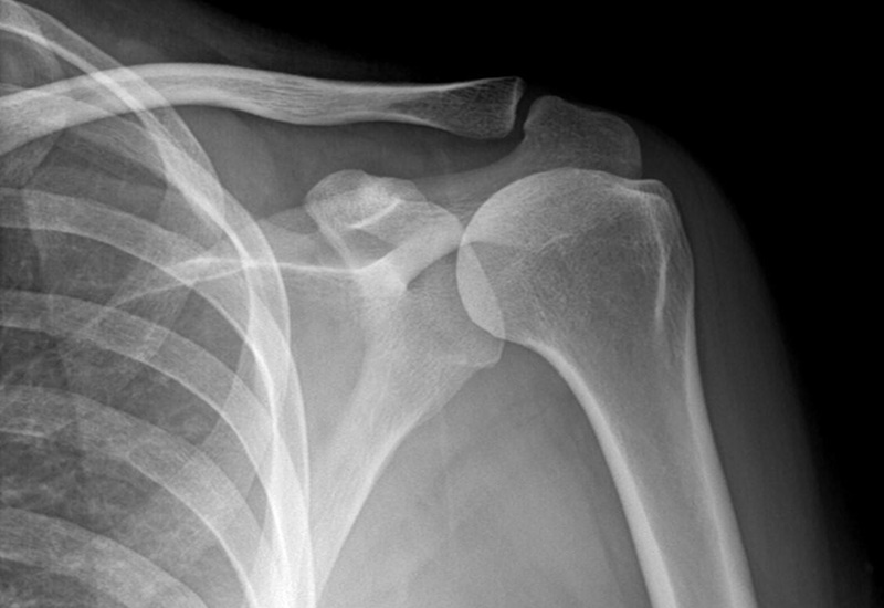 Chụp X-quang là phương pháp khám xương khớp phổ biến