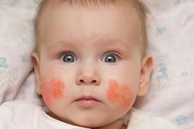 Trẻ bị chàm sữa xuất hiện thêm các dấu hiệu về dị ứng của bệnh lý viêm mũi hoặc hen suyễn