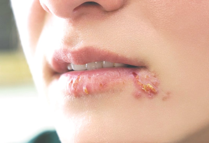 Nguyên nhân gây mụn rộp ở môi là do virus HSV gây nên