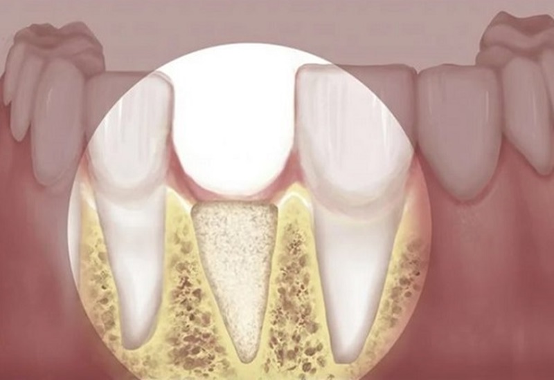 Tiêu xương ổ răng gây ra nhiều hậu quả nghiêm trọng