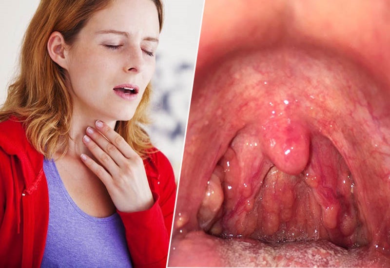 Viêm họng hạt có mủ khiến người bệnh bị đau họng âm ỉ