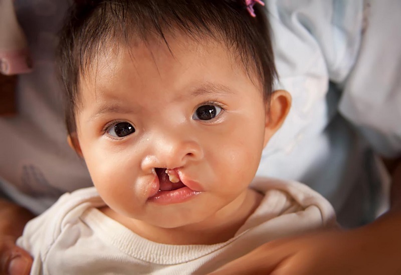 Sứt môi hở hàm ếch là dị tật bẩm sinh ở trẻ em