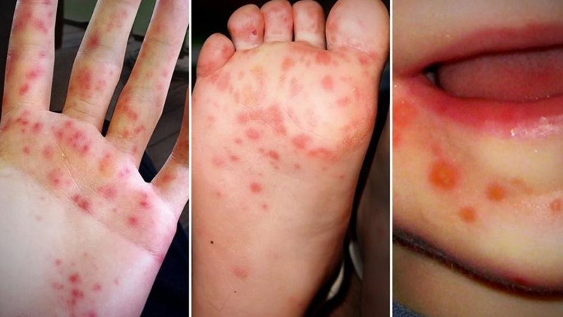 Đối tượng dễ mắc tay chân miệng là trẻ em dưới 5 tuổi vì hệ miễn dịch của bé chưa được hoàn thiện