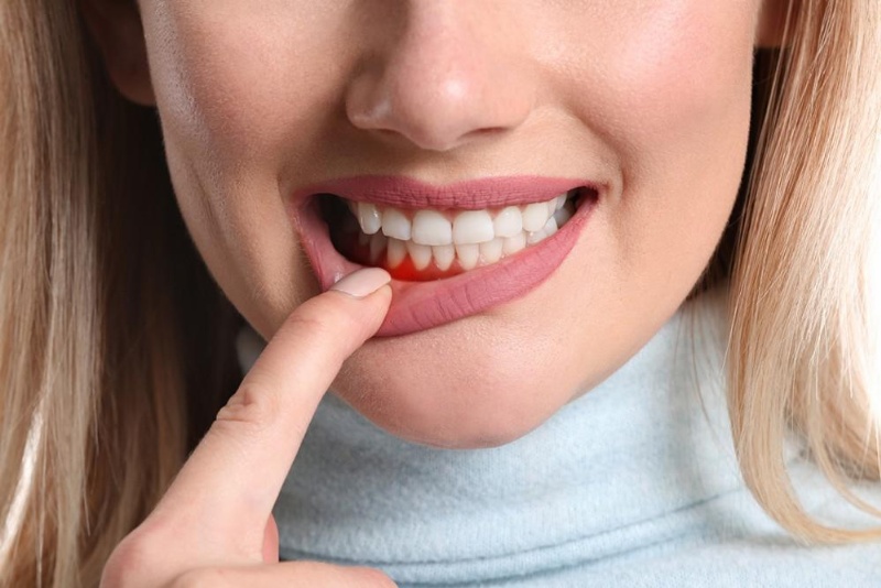 Tăng tiểu cầu tiên phát gây ra xuất huyết gây chảy máu chân răng