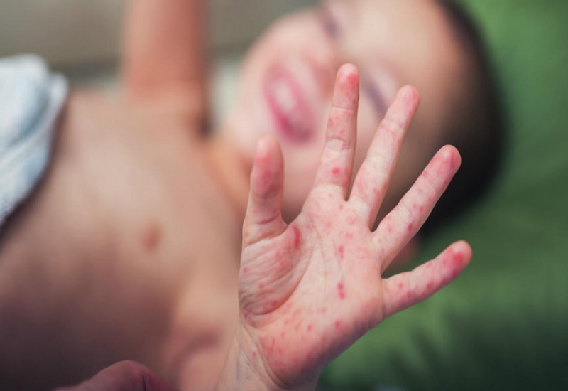 Trẻ nổi ban sau sốt có thể do bệnh tay chân miệng