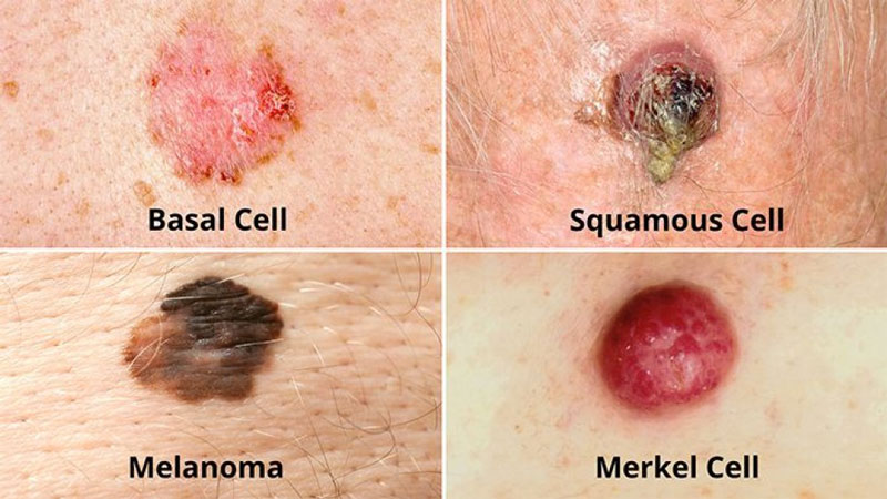 Bệnh ung thư da phát triển dưới nhiều dạng khác nhau