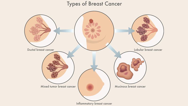 Ung thư vú có nhiều dạng khác nhau