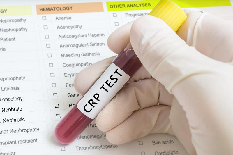 Xét nghiệm định lượng CRP nhằm đánh giá mức độ nghiệm trọng của bệnh