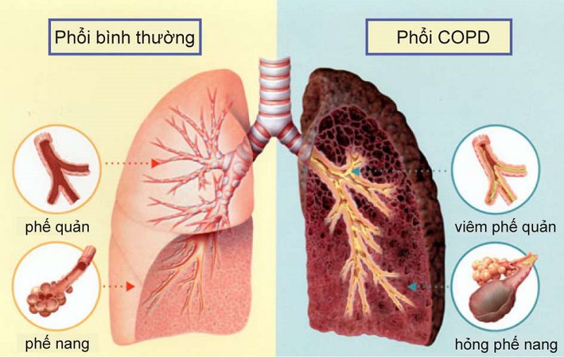 Phổi khỏe mạnh và phổi khi bị COPD